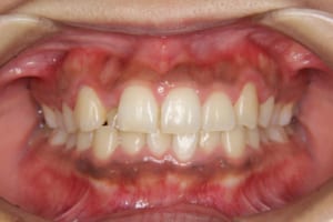 矯正歯科治療前（正面）。叢生、正中のずれがあります。